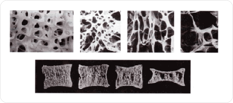 해면골의 미세구조 변화와 척추 골절의 진행도