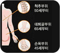 골다공증에 의한 골절 발생부위-척추부위 50세부터,대퇴골부위-65세부터,손목부위-45세부터