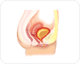 일류성 요실금 이미지