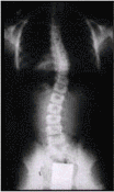 척추측만증 엑스레이 이미지2